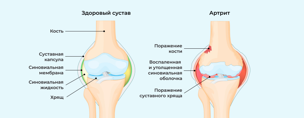 сохранить подвижность суставов