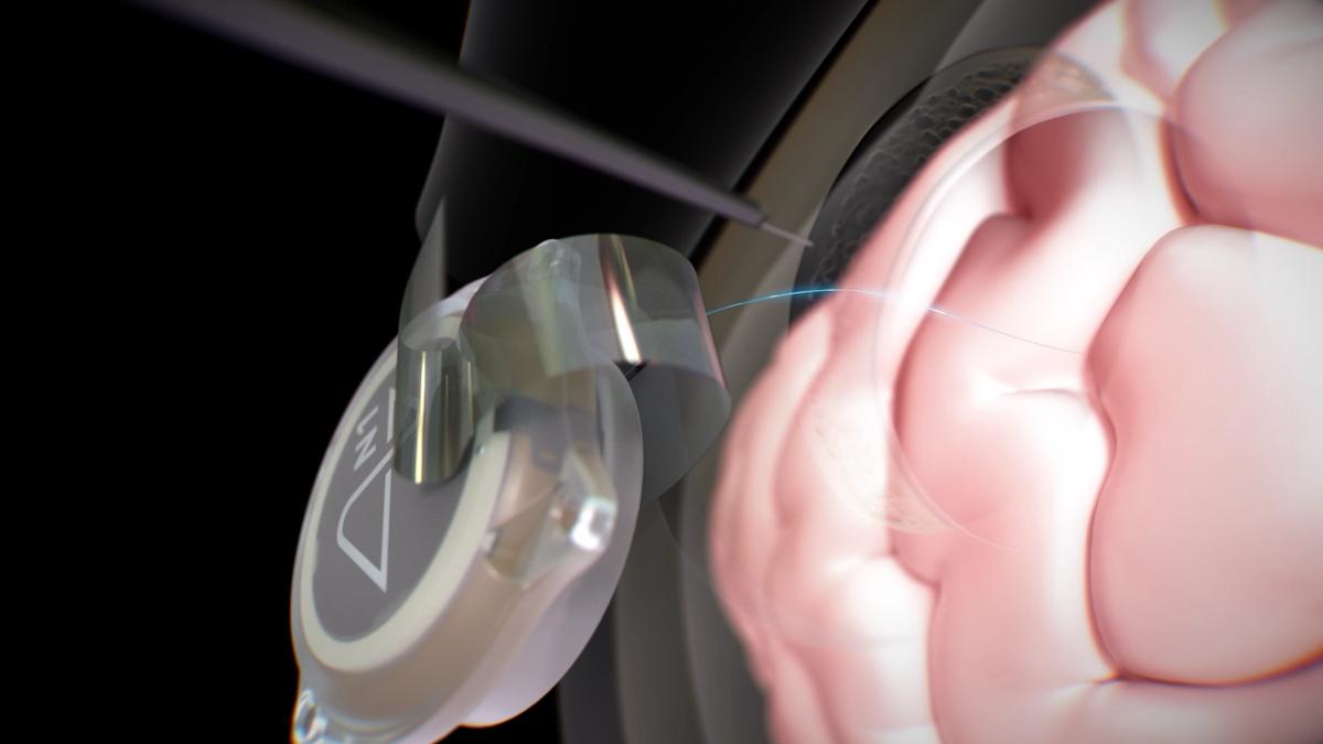 мозговые импланты